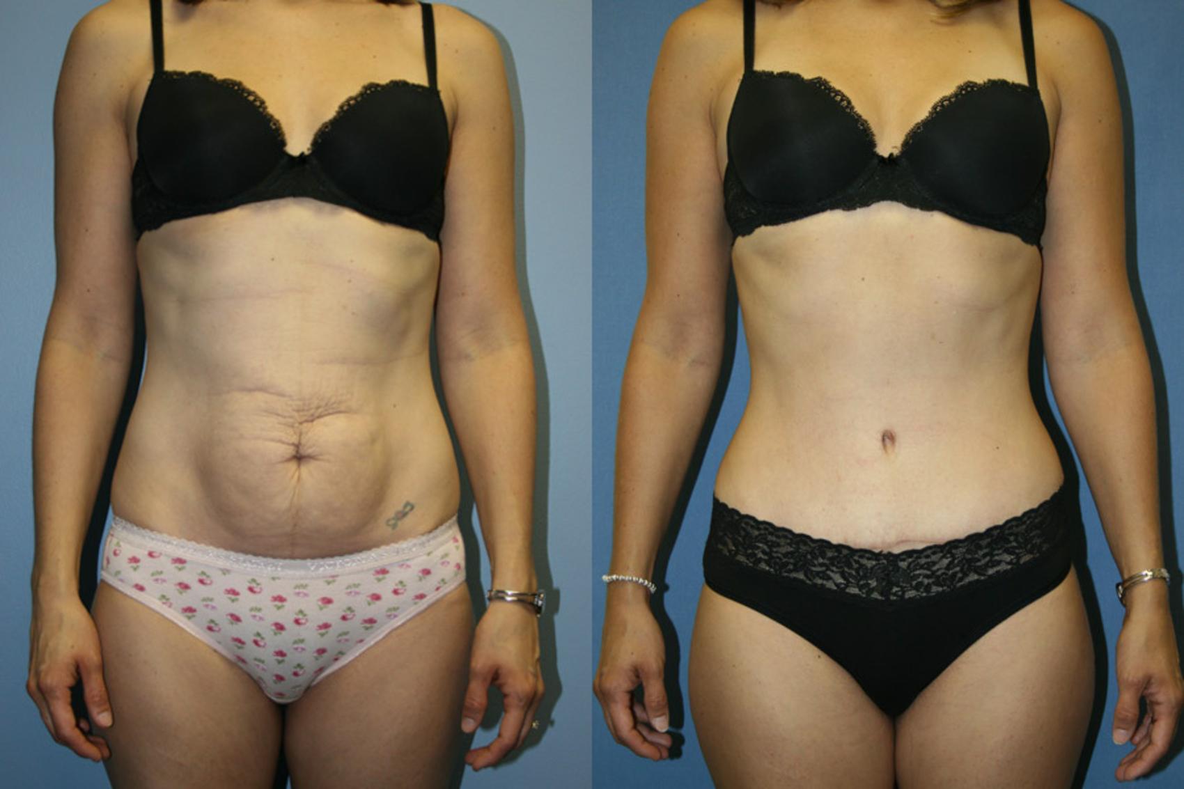 Tummy Tuck Case 12 Before & After View #1 | Downers Grove, IL | Dr. Sandeep Jejurikar