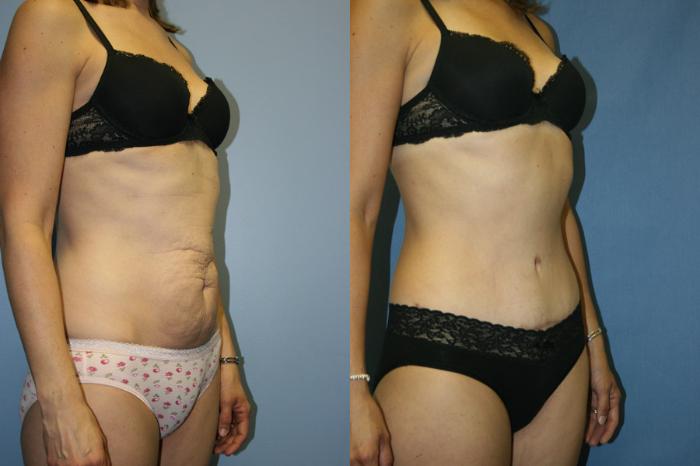 Tummy Tuck Case 12 Before & After View #2 | Downers Grove, IL | Dr. Sandeep Jejurikar