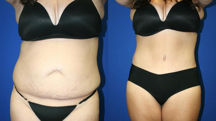 Tummy Tuck Case 122 Before & After Front | Downers Grove, IL | Dr. Sandeep Jejurikar