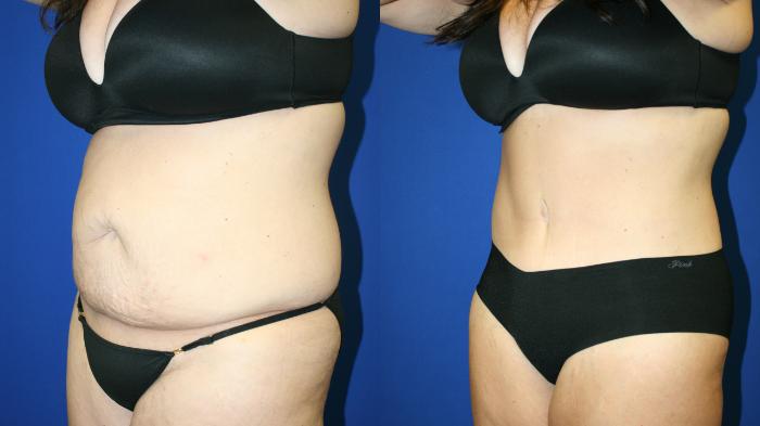 Tummy Tuck Case 122 Before & After Left Oblique | Downers Grove, IL | Dr. Sandeep Jejurikar