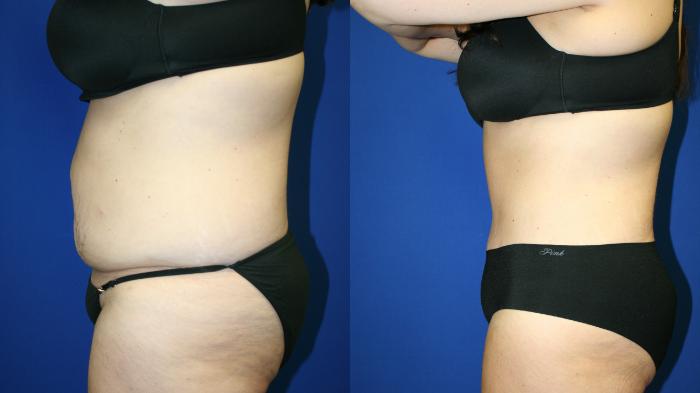 Tummy Tuck Case 122 Before & After Left Side | Downers Grove, IL | Dr. Sandeep Jejurikar