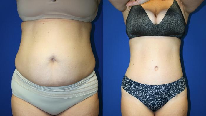 Tummy Tuck Case 125 Before & After Front | Downers Grove, IL | Dr. Sandeep Jejurikar