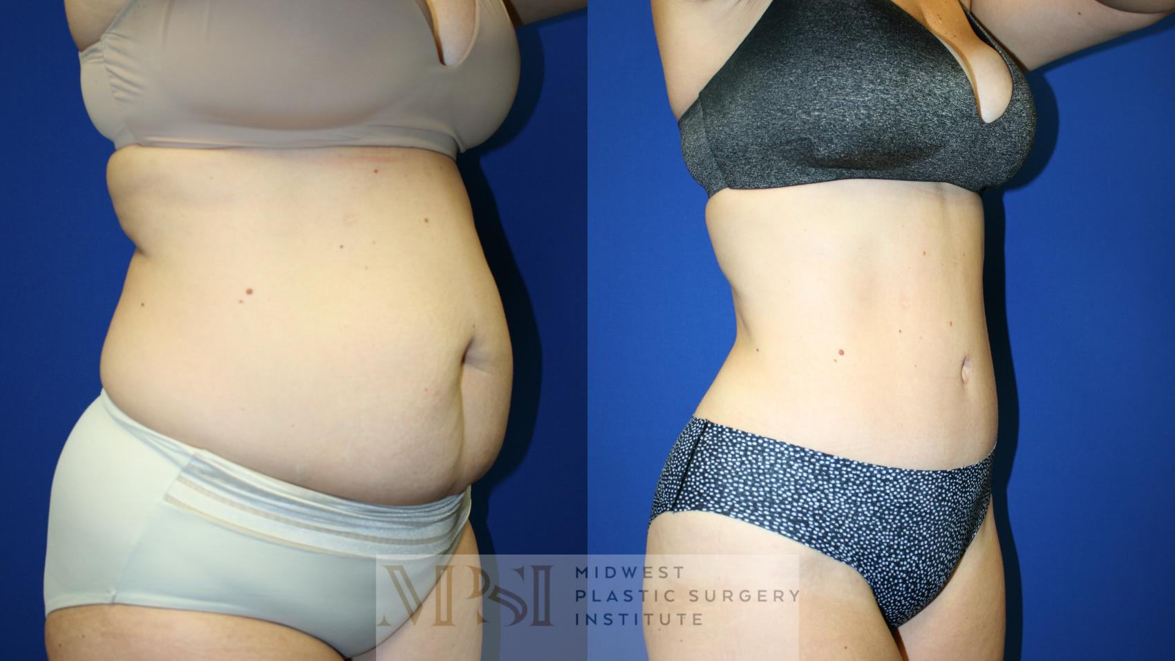 Tummy Tuck Case 125 Before & After Right Oblique | Downers Grove, IL | Dr. Sandeep Jejurikar