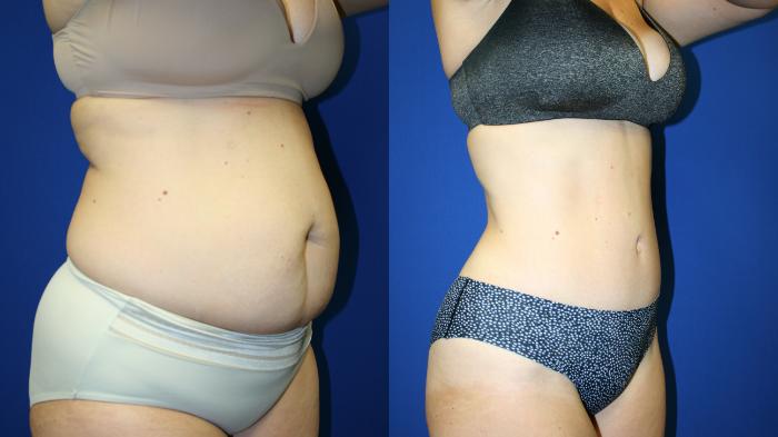 Tummy Tuck Case 125 Before & After Right Oblique | Downers Grove, IL | Dr. Sandeep Jejurikar