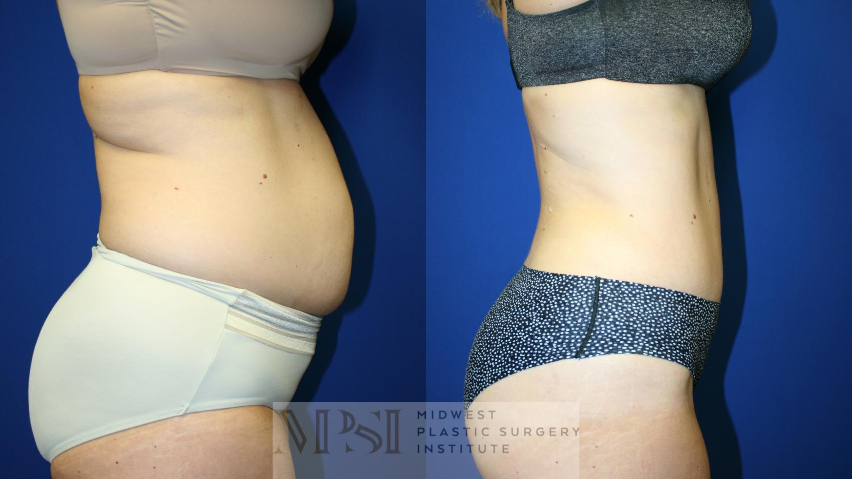 Tummy Tuck Case 125 Before & After Right Side | Downers Grove, IL | Dr. Sandeep Jejurikar