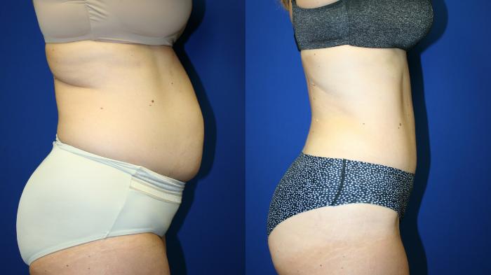 Tummy Tuck Case 125 Before & After Right Side | Downers Grove, IL | Dr. Sandeep Jejurikar