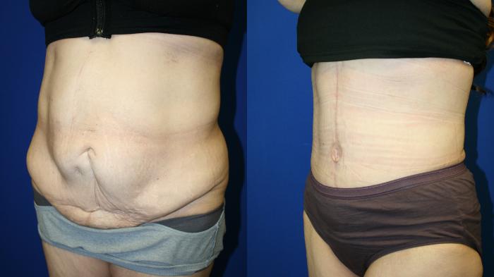 Tummy Tuck Case 139 Before & After Left Oblique | Downers Grove, IL | Dr. Sandeep Jejurikar