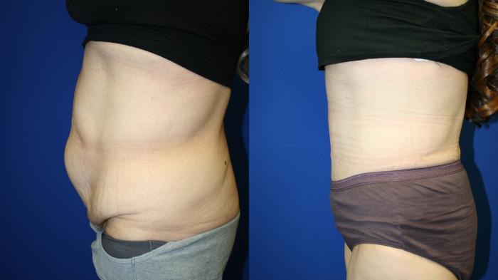 Tummy Tuck Case 139 Before & After Left Side | Downers Grove, IL | Dr. Sandeep Jejurikar