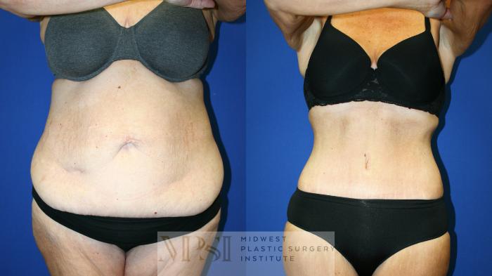 Liposuction Case 142 Before & After Front | Downers Grove, IL | Dr. Sandeep Jejurikar