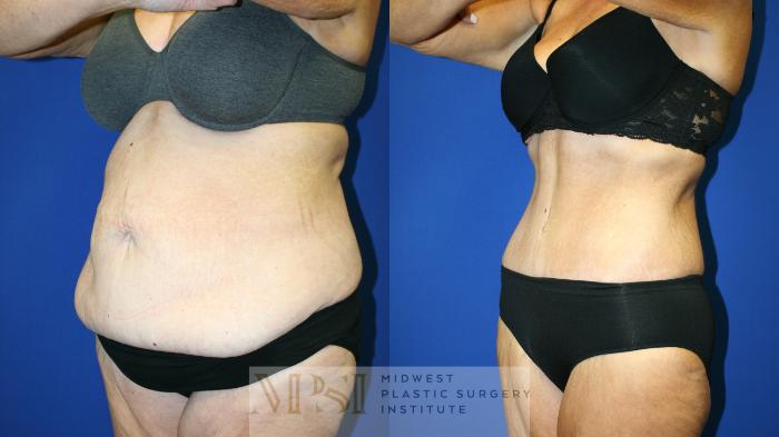 Tummy Tuck Case 142 Before & After Left Oblique | Downers Grove, IL | Dr. Sandeep Jejurikar