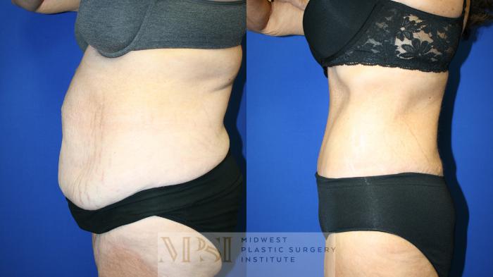Tummy Tuck Case 142 Before & After Left Side | Downers Grove, IL | Dr. Sandeep Jejurikar