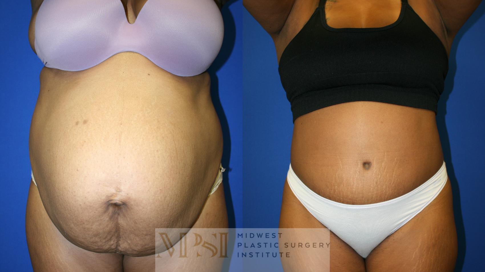 Tummy Tuck Case 143 Before & After Front | Downers Grove, IL | Dr. Sandeep Jejurikar