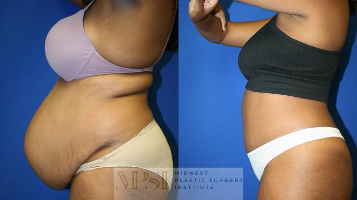 Tummy Tuck Case 143 Before & After Left Side | Downers Grove, IL | Dr. Sandeep Jejurikar