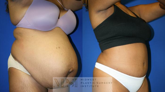 Tummy Tuck Case 143 Before & After Right Oblique | Downers Grove, IL | Dr. Sandeep Jejurikar