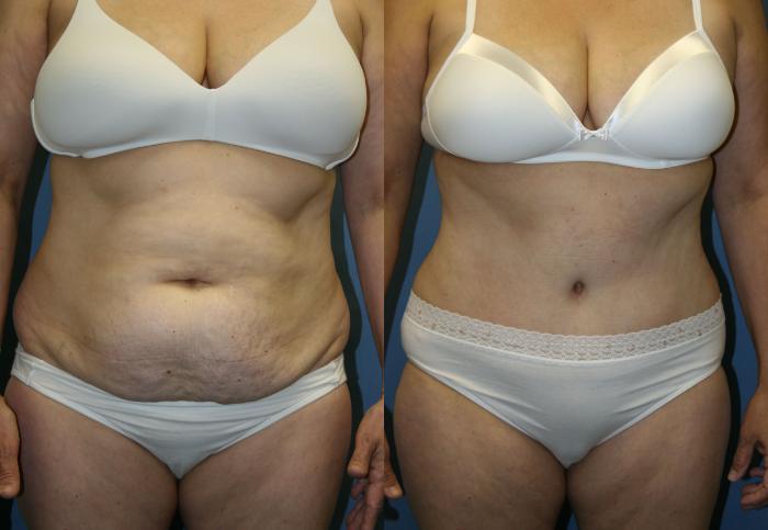 Tummy Tuck Case 23 Before & After View #1 | Downers Grove, IL | Dr. Sandeep Jejurikar