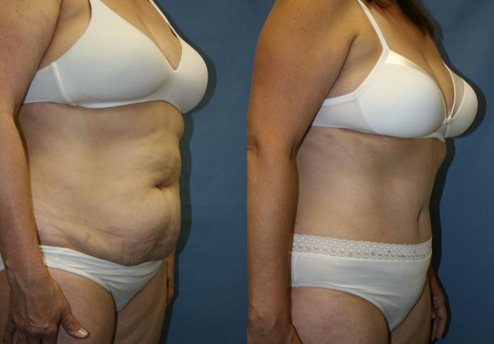 Tummy Tuck Case 23 Before & After View #4 | Downers Grove, IL | Dr. Sandeep Jejurikar