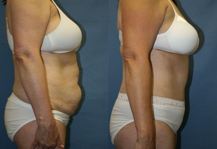 Tummy Tuck Case 23 Before & After View #6 | Downers Grove, IL | Dr. Sandeep Jejurikar