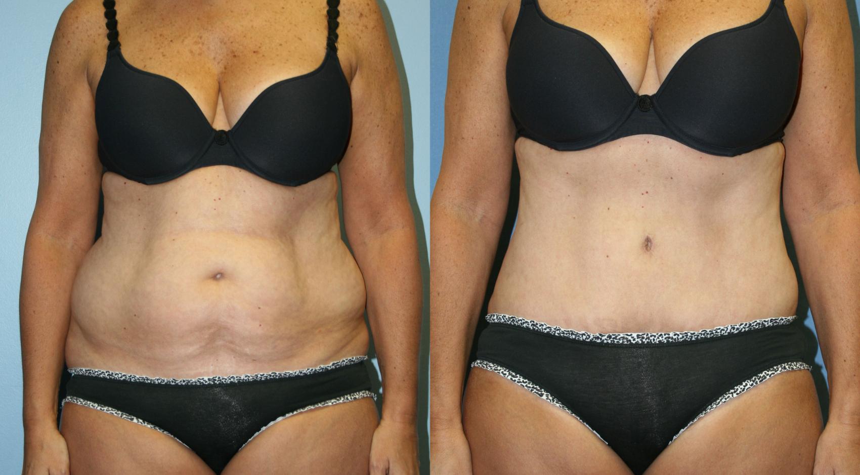 Liposuction Case 30 Before & After View #1 | Downers Grove, IL | Dr. Sandeep Jejurikar