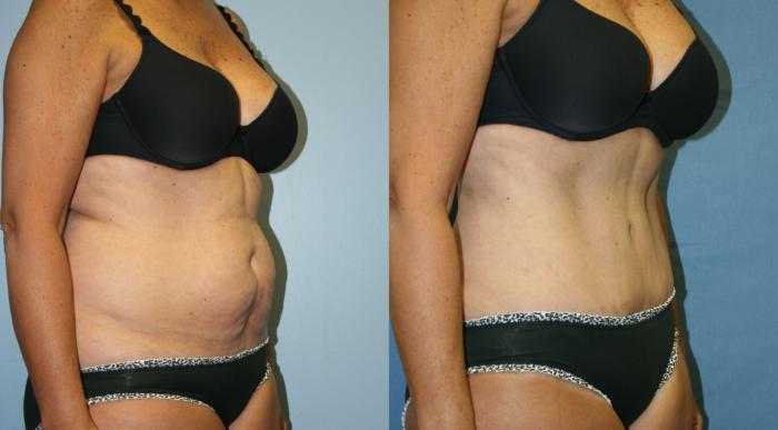 Tummy Tuck Case 30 Before & After View #2 | Downers Grove, IL | Dr. Sandeep Jejurikar