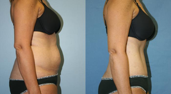 Tummy Tuck Case 30 Before & After View #3 | Downers Grove, IL | Dr. Sandeep Jejurikar