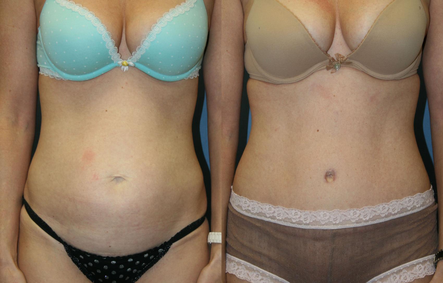 Tummy Tuck Case 34 Before & After View #1 | Downers Grove, IL | Dr. Sandeep Jejurikar