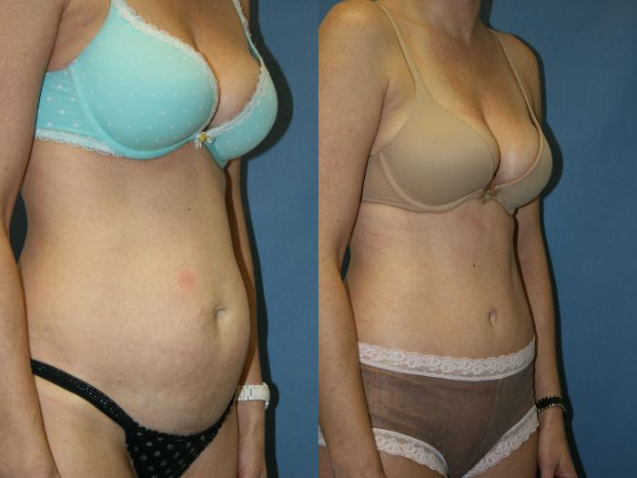 Tummy Tuck Case 34 Before & After View #3 | Downers Grove, IL | Dr. Sandeep Jejurikar
