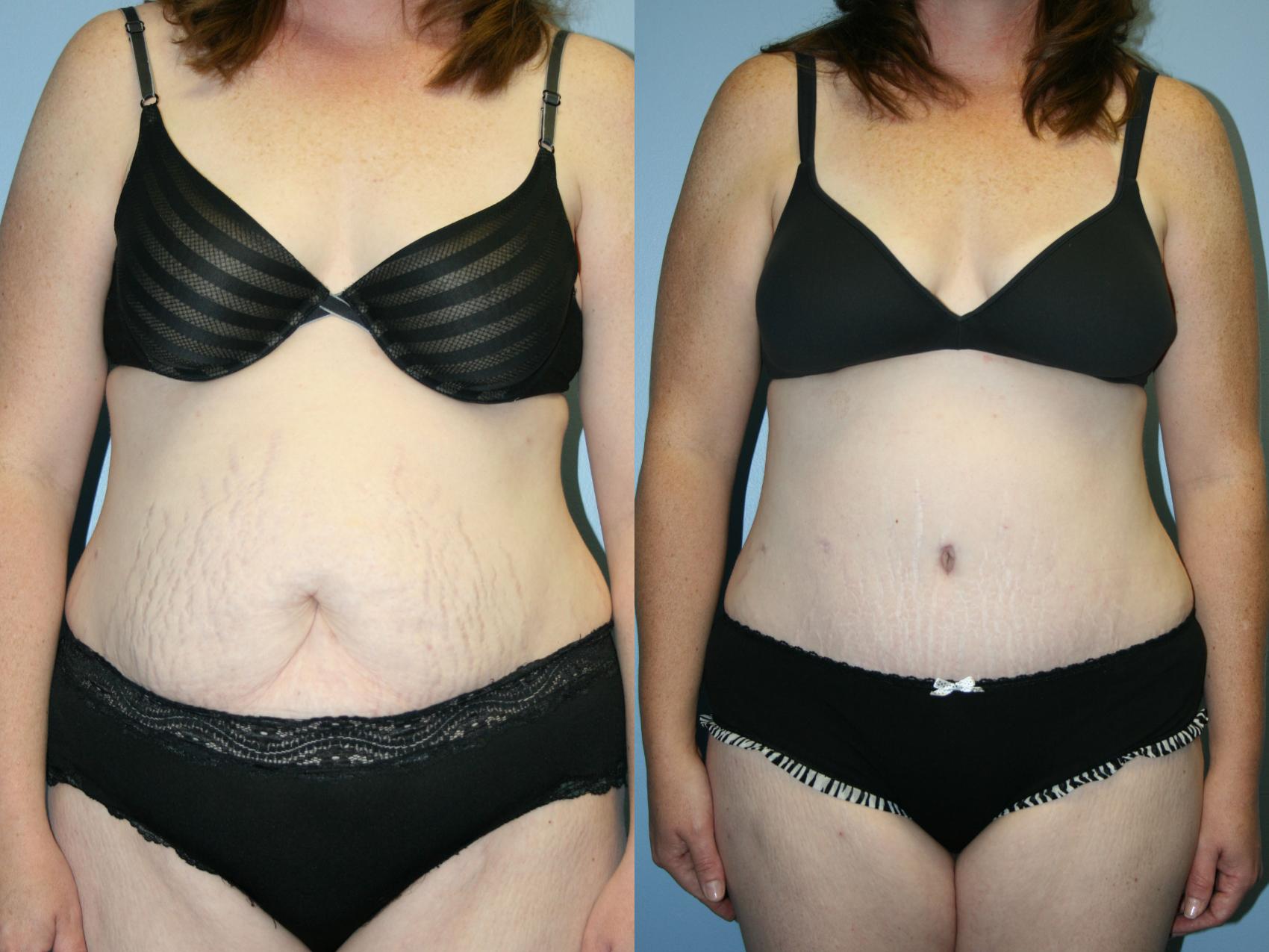 Before & After: Abdominoplasty & Liposuction