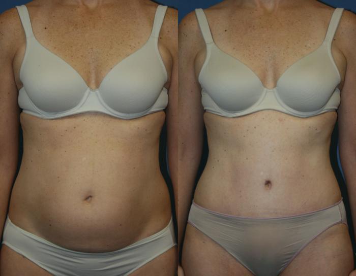 Tummy Tuck Case 39 Before & After View #1 | Downers Grove, IL | Dr. Sandeep Jejurikar