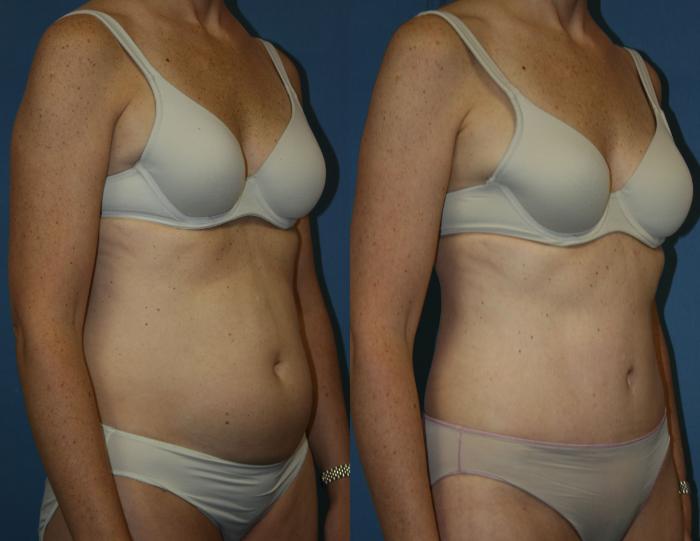 Tummy Tuck Case 39 Before & After View #2 | Downers Grove, IL | Dr. Sandeep Jejurikar