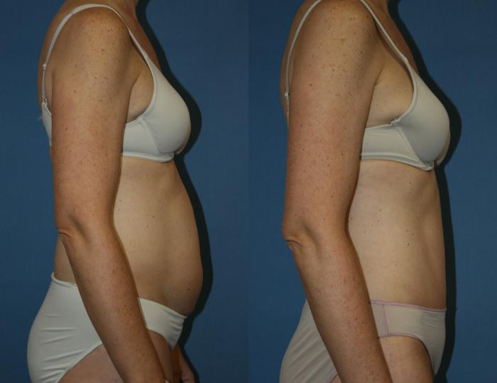 Tummy Tuck Case 39 Before & After View #5 | Downers Grove, IL | Dr. Sandeep Jejurikar