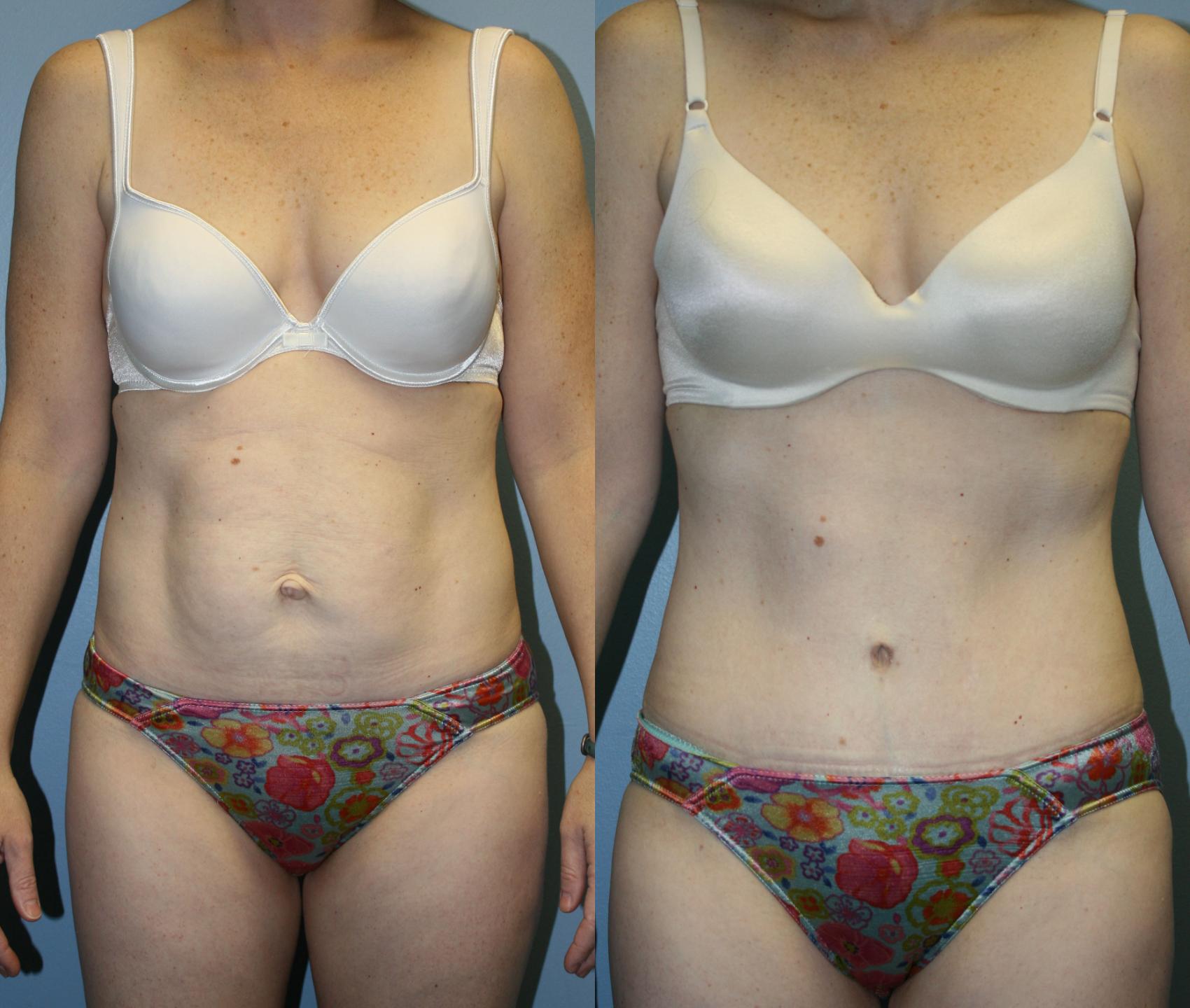 Tummy Tuck Case 40 Before & After View #1 | Downers Grove, IL | Dr. Sandeep Jejurikar