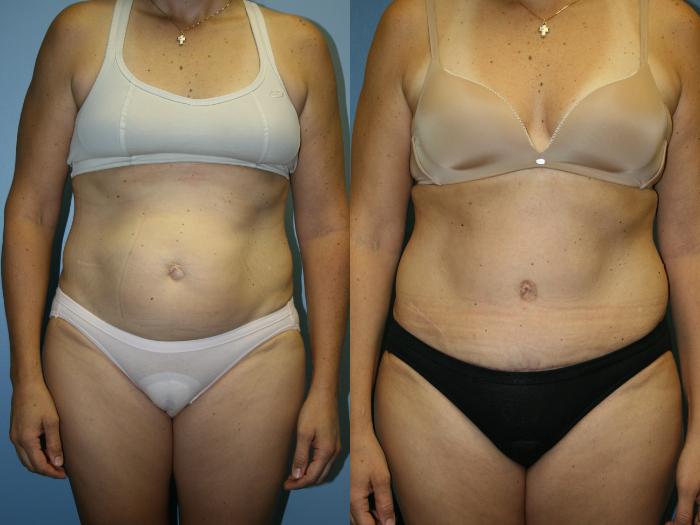 Tummy Tuck Case 41 Before & After View #1 | Downers Grove, IL | Dr. Sandeep Jejurikar