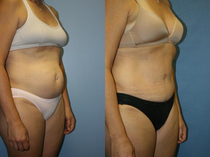 Tummy Tuck Case 41 Before & After View #2 | Downers Grove, IL | Dr. Sandeep Jejurikar