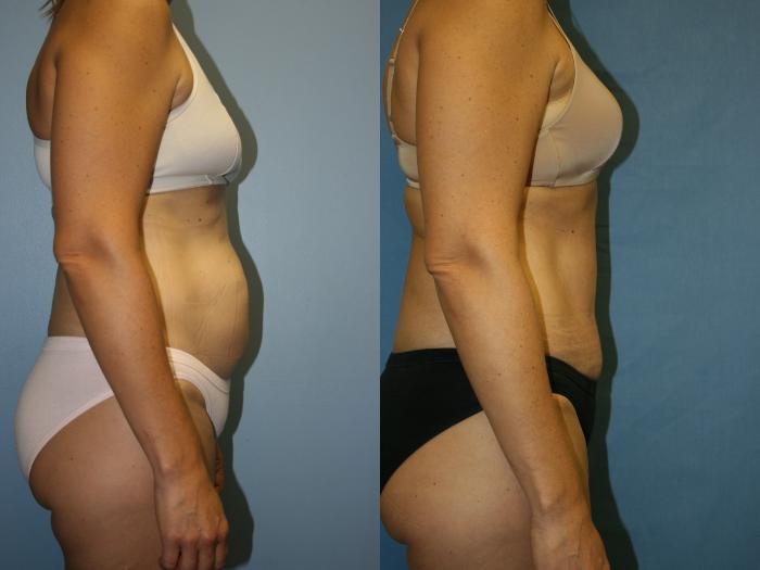 Before & After: Abdominoplasty