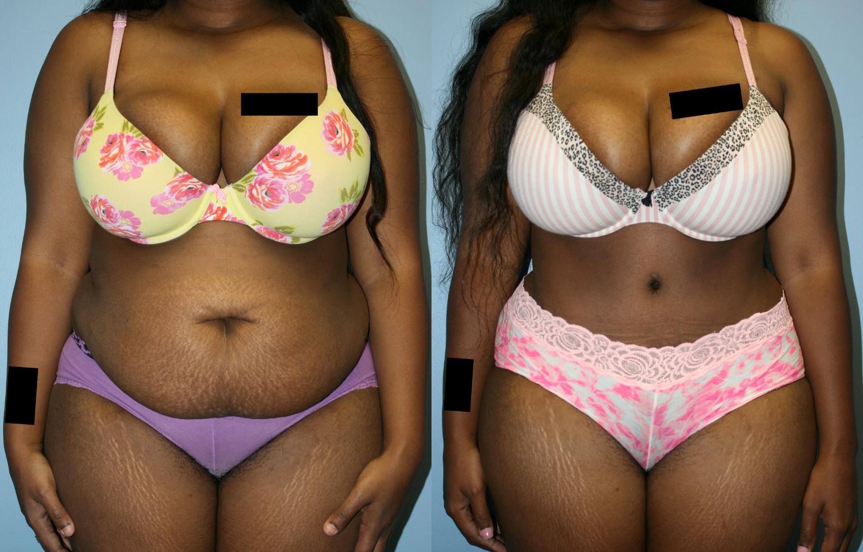 Plus Size Tummy Tuck Before and After