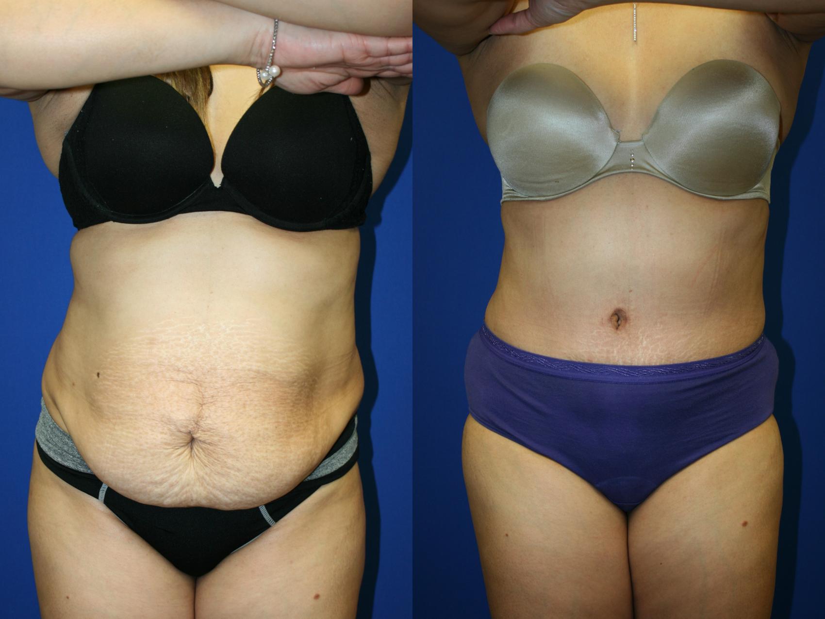 Tummy Tuck Case 52 Before & After Front | Downers Grove, IL | Dr. Sandeep Jejurikar