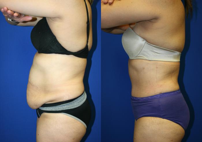 Before & After: Tummy tuck