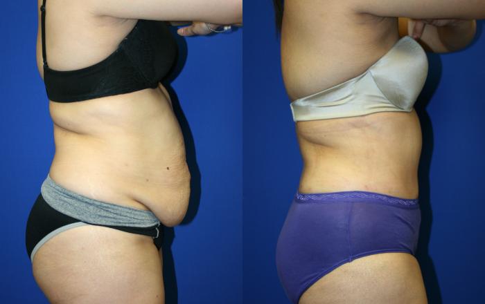 Tummy Tuck Case 52 Before & After Right Side | Downers Grove, IL | Dr. Sandeep Jejurikar