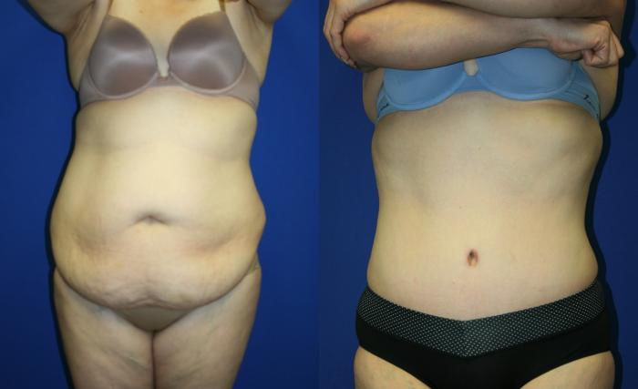 Tummy Tuck Case 62 Before & After Front | Downers Grove, IL | Dr. Sandeep Jejurikar