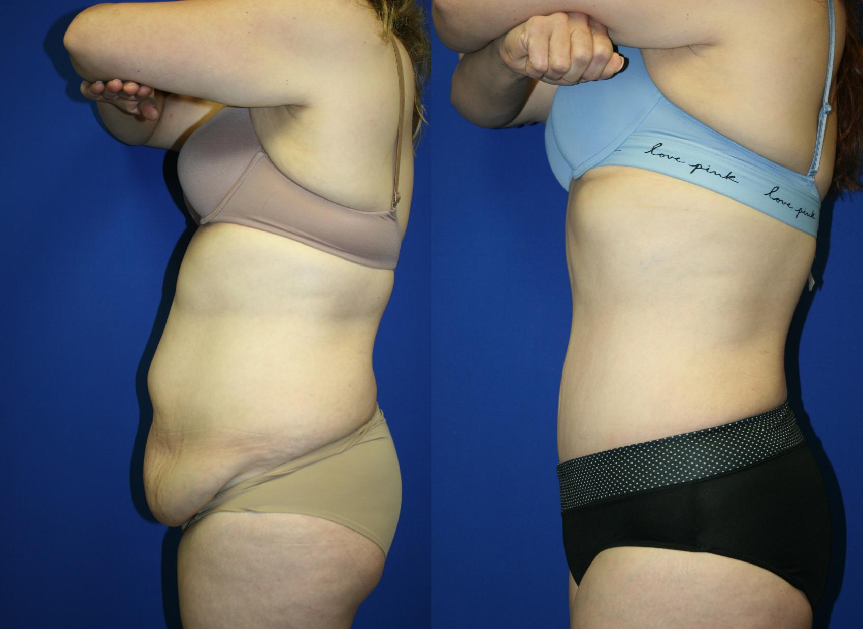 Tummy Tuck Case 62 Before & After Left Side | Downers Grove, IL | Dr. Sandeep Jejurikar