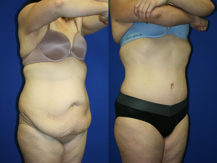 Liposuction Case 62 Before & After Right Oblique | Downers Grove, IL | Dr. Sandeep Jejurikar