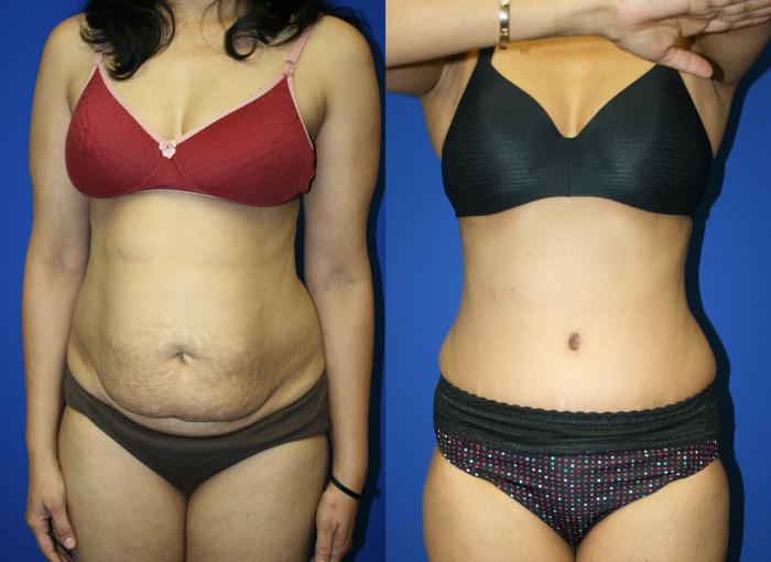 Tummy Tuck Case 69 Before & After Front | Downers Grove, IL | Dr. Sandeep Jejurikar