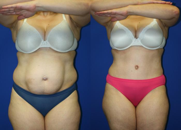 Tummy Tuck Case 71 Before & After Front | Downers Grove, IL | Dr. Sandeep Jejurikar