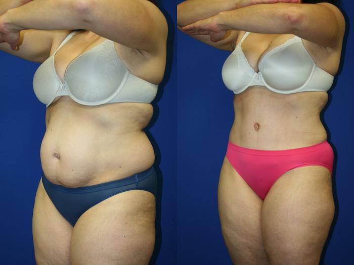 Liposuction Case 71 Before & After Left Oblique | Downers Grove, IL | Dr. Sandeep Jejurikar