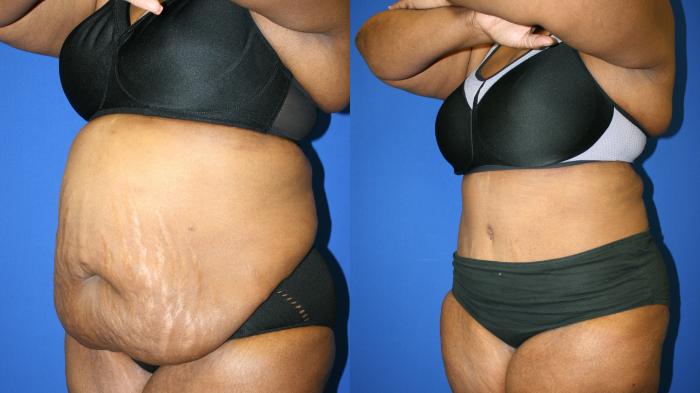 Liposuction Case 76 Before & After Left Oblique | Downers Grove, IL | Dr. Sandeep Jejurikar