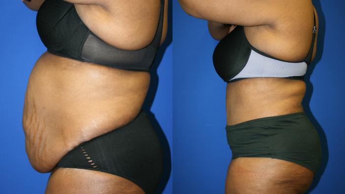 Tummy Tuck Case 76 Before & After Left Side | Downers Grove, IL | Dr. Sandeep Jejurikar