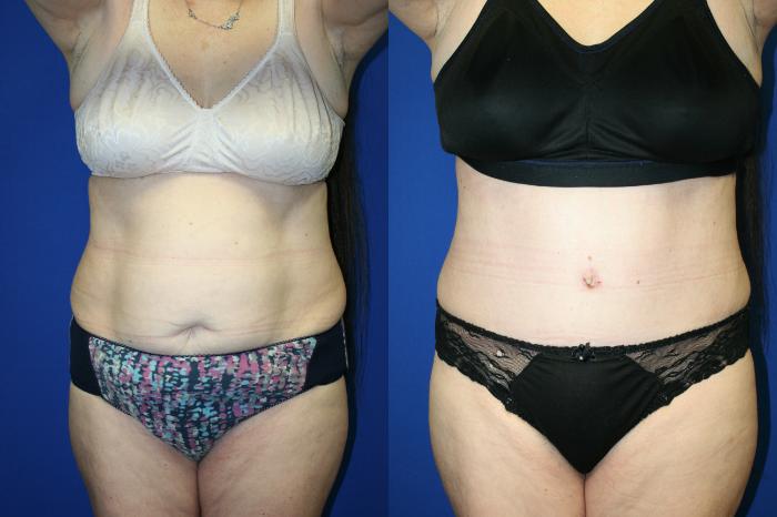 Tummy Tuck Case 80 Before & After Front | Downers Grove, IL | Dr. Sandeep Jejurikar