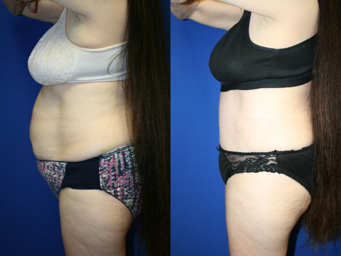 Tummy Tuck Case 80 Before & After Left Side | Downers Grove, IL | Dr. Sandeep Jejurikar