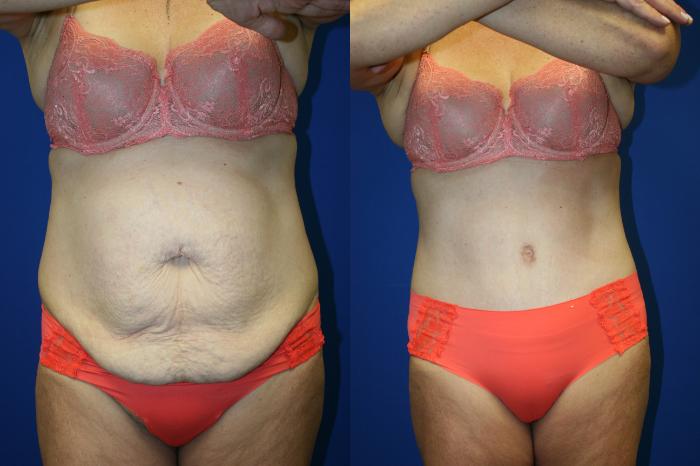 Tummy Tuck Case 81 Before & After Front | Downers Grove, IL | Dr. Sandeep Jejurikar