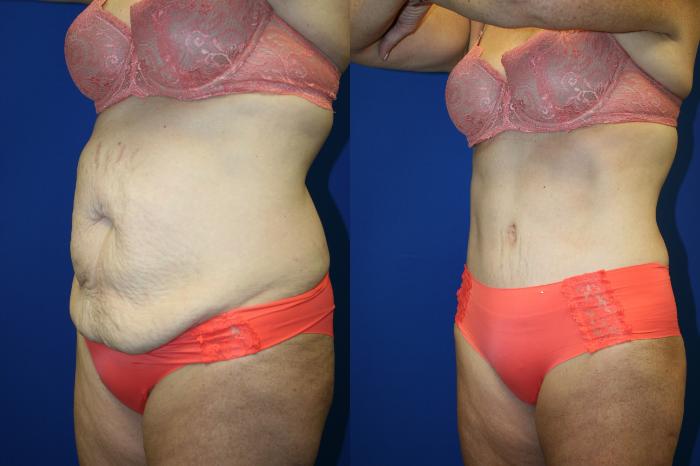 Liposuction Case 81 Before & After Left Oblique | Downers Grove, IL | Dr. Sandeep Jejurikar